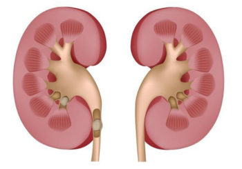 kidney stone disease 1